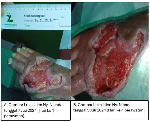Perawatan Luka Hari ke 1 dan Hari ke 4